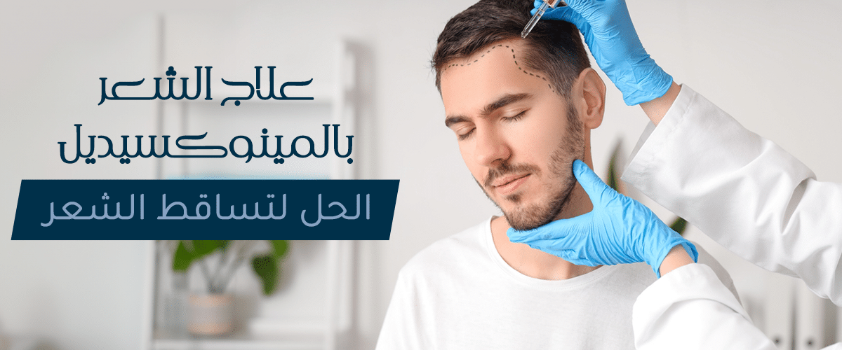 علاج الشعر بالمينوكسيديل